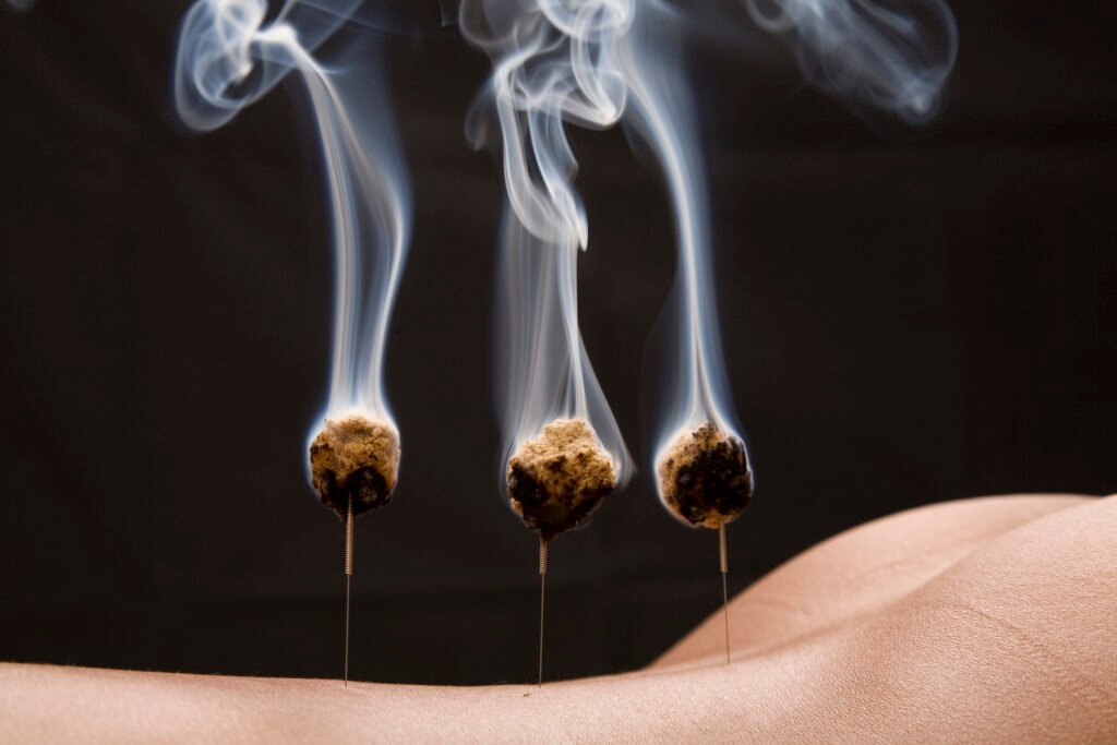 Bolas de moxa encendidas sobre agujas de acupuntura en la espalda